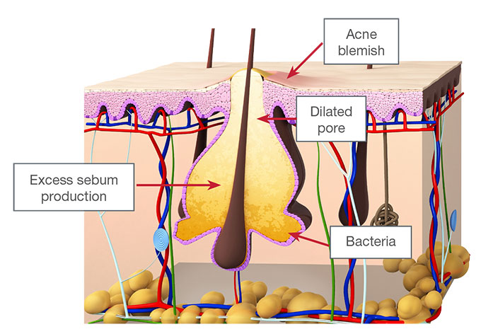 Acne skin